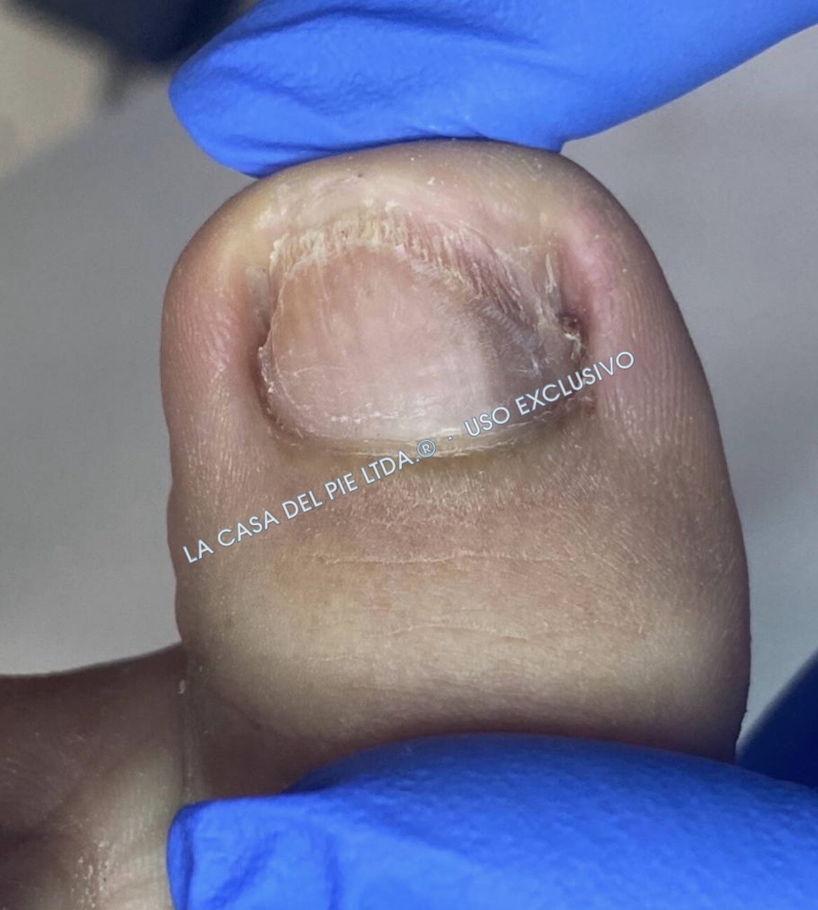 Onicomicosis, antes del procedimiento
